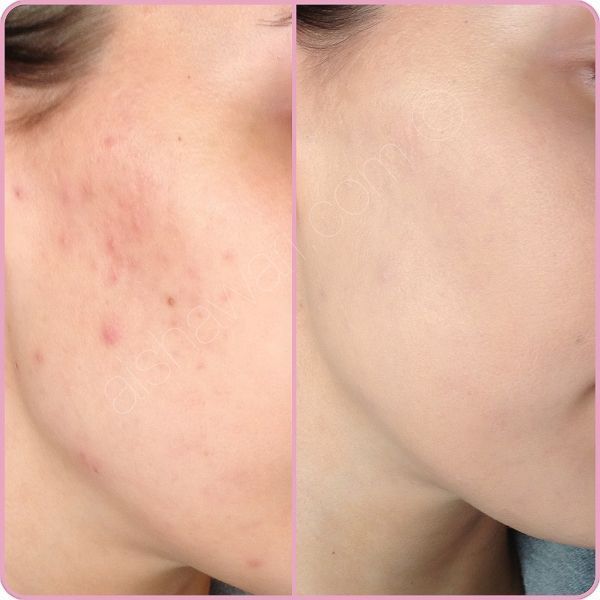 PRISTA Ecluxe – Niacinamide 10% + (Vitamin B3)
